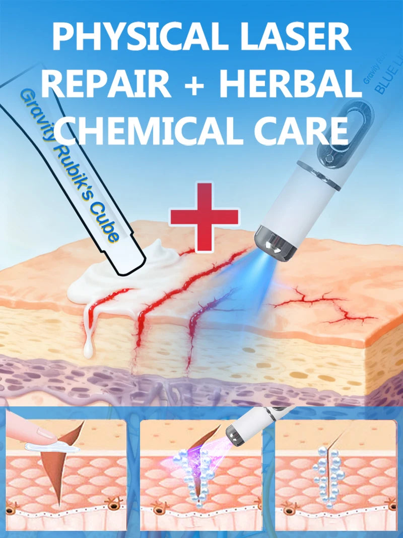 Striae Laser Device Eliminate Body Stretch Marks Products