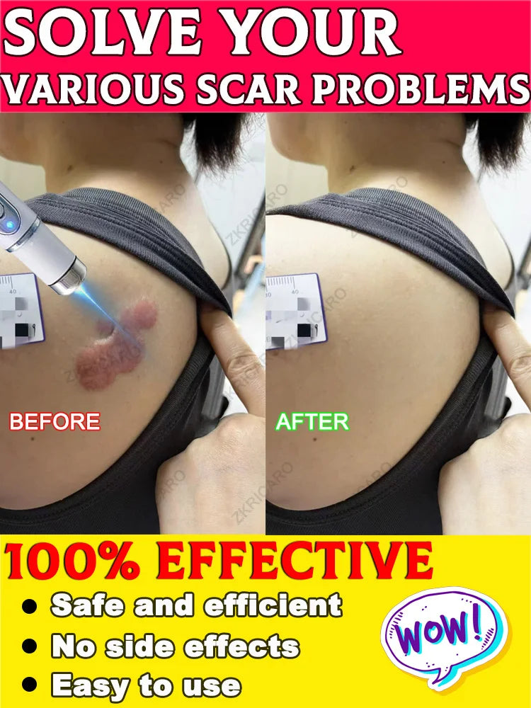 Want to get rid of scars, try this