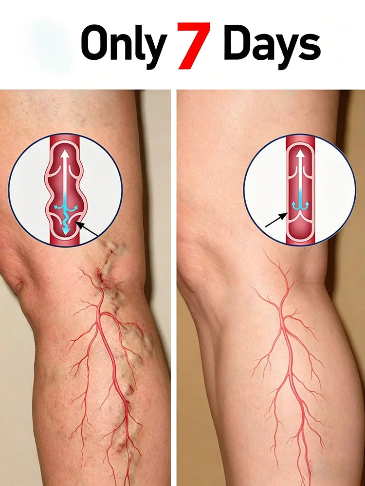 2 in 1 Effective treatment for varicose veins, relieves dilated vasculitis of leg phlebitis, avoids surgical pain,Unisex