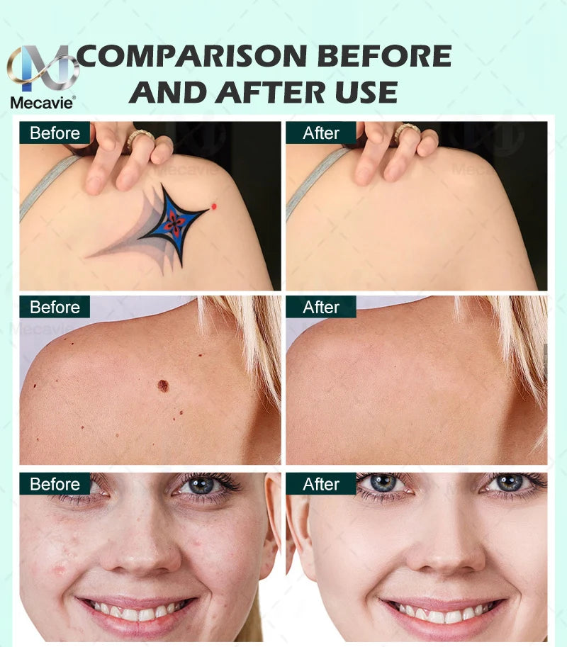 2026 Newest 2-in-1 Soprano 4000W 808nm Diode Laser Hair Removal Device 4-Wave Painless Permanent + Pico Tattoo Removal