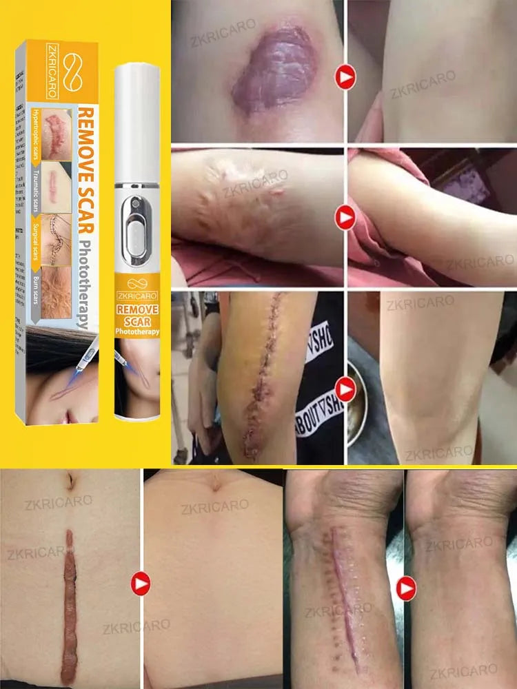 Want to get rid of scars, try this