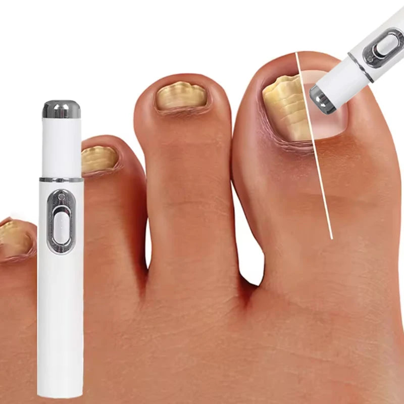 Fifth generation nail laser pen helps you say goodbye to onychomycosis. Technology changes your life.