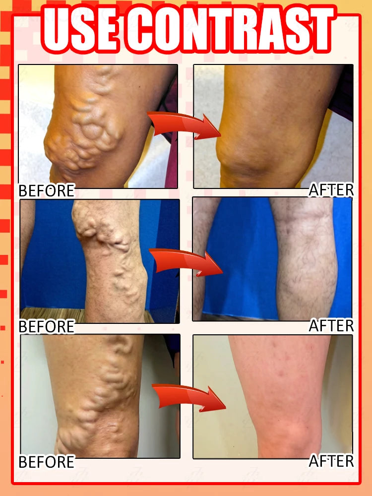 It's your best choice to say goodbye to pain and discomfort, restore your legs' natural luster, and is suitable for everyone.