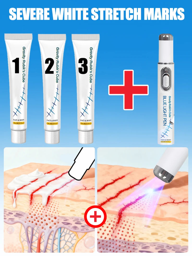 Striae Laser Device Eliminate Body Stretch Marks Products