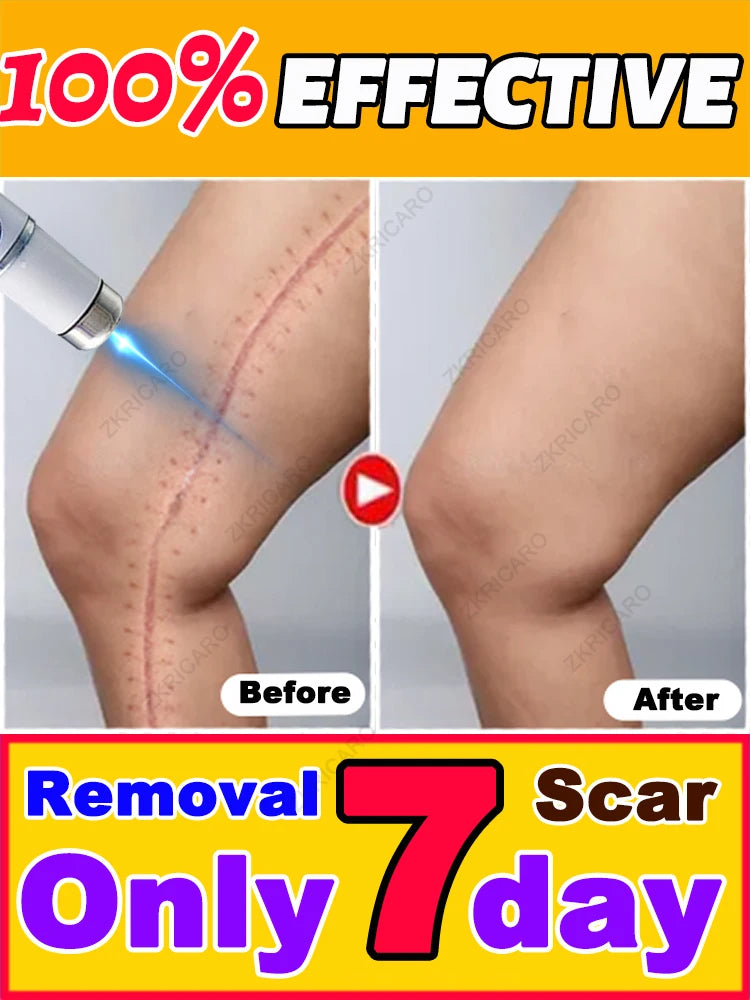 Want to get rid of scars, try this