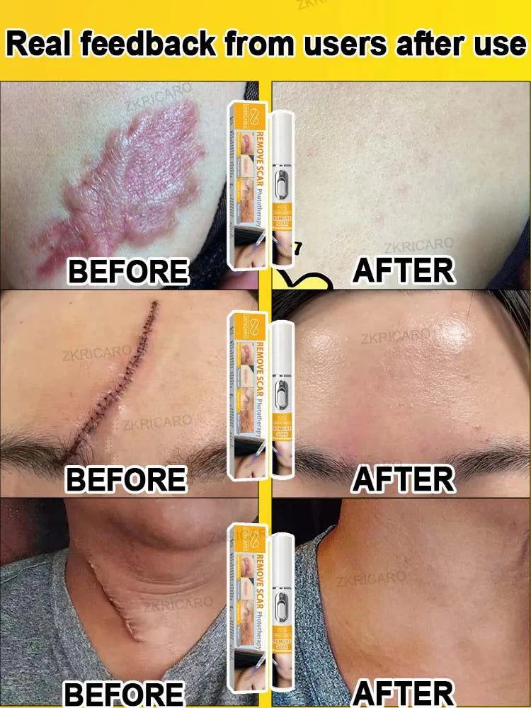 Want to get rid of scars, try this